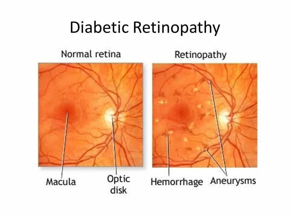 The Potential Role of Azilsartan in Treating Hypertensive Retinopathy