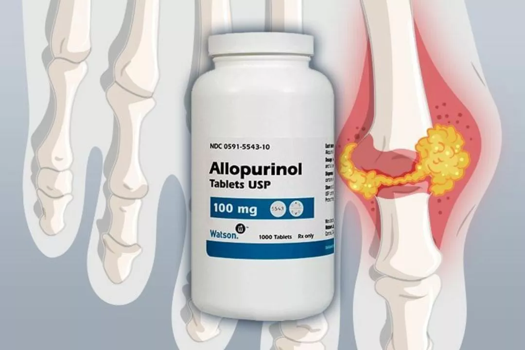 The Role of Allopurinol in Managing Gout and Hyperuricemia